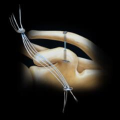 اصلاح مفصل آکرومیوکلاویکولار (AC Joint)
